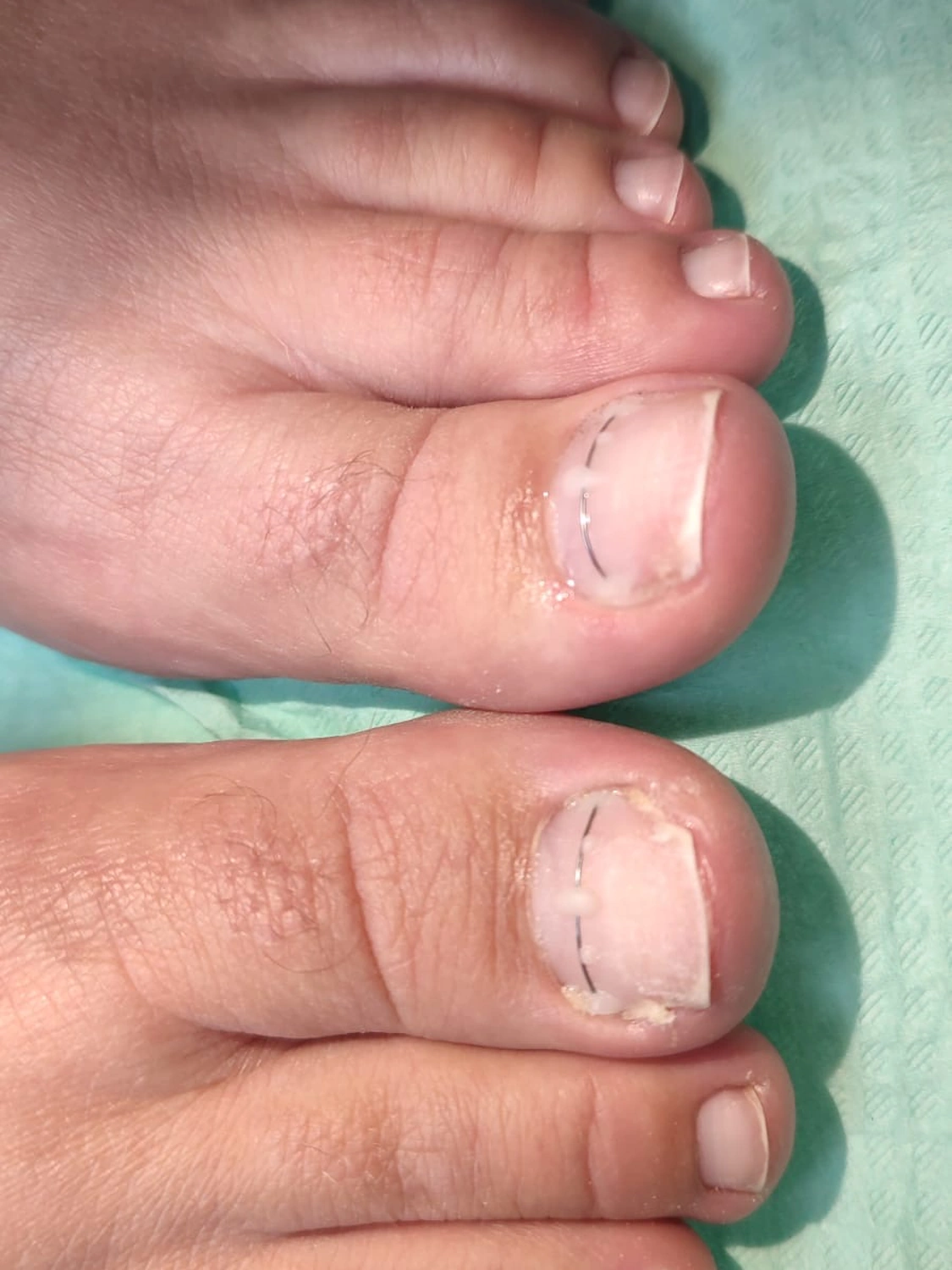 NiTi rovnátko - aplikováno