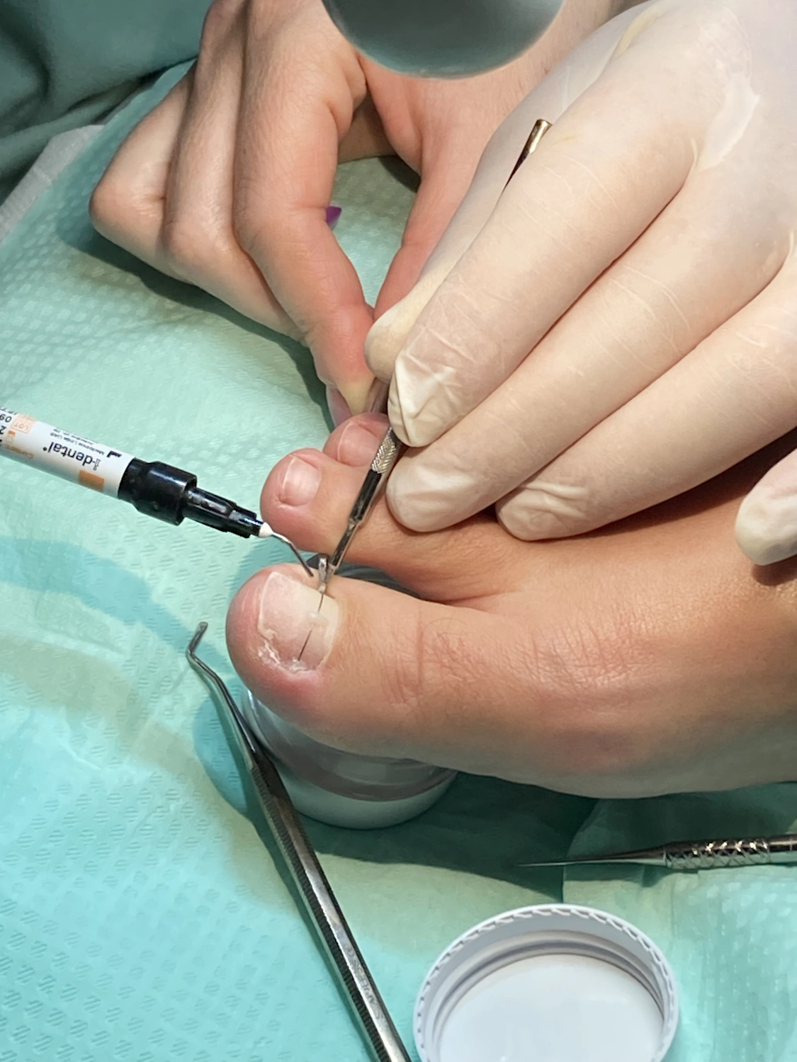 Niti rovnátka - aplikace